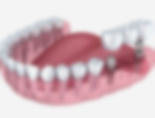 常州地区种植牙项目价格参考